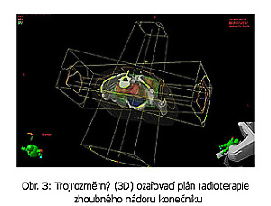 Trojrozměrný (3D) ozařovací plán radioterapie zhoubného nádoru konečníku