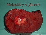 jaterní metastázy