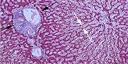 Zhoubný nádor jater (označen šipkami) při mikroskopickém vyšetření