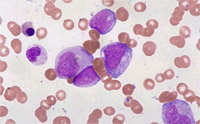 Blasty akutní myeloidní leukemie.
