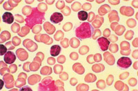 Buňky chronické lymfatické leukemie (malé tmavé buňky).