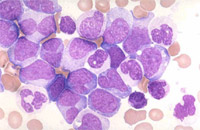Buňky chronické myeloidní leukemie.