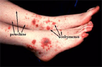 Tečkovité krvácení v kůži bérců u nemocného s leukemií (petechie) a větší splývavé krvácení (ekchymózy).
