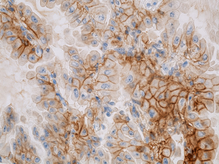  Exprese PD-L1 na buňkách nemalobuněčného plicního karcinomu (autor: A. Ryška)
