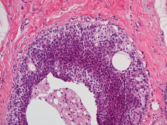 duktalní karcinom prsu in situ