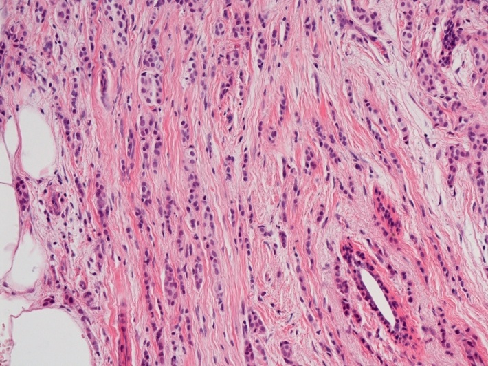 lobulární invazivní karcinom prsu